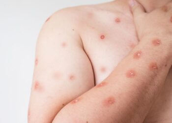 Piracicaba registra caso suspeito de mpox, informa Secretaria de Saúde