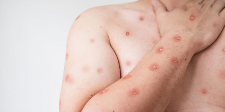 Piracicaba registra caso suspeito de mpox, informa Secretaria de Saúde